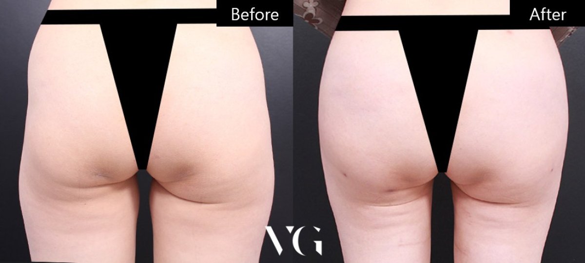 نتائج شفط الدهون قبل وبعد في VG Plastic Surgery، تحسين شكل الجسم وتنسيقه