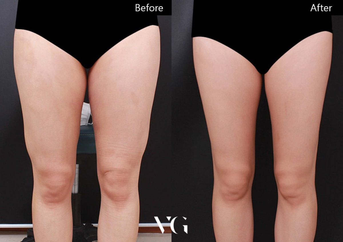 نتائج شفط الدهون قبل وبعد في VG Plastic Surgery، أفخاذ أنحف وبشرة أكثر نعومة