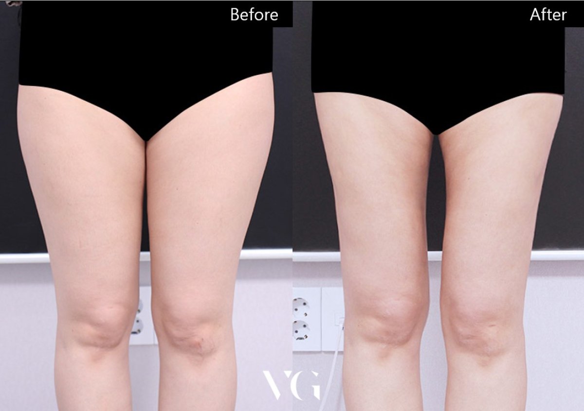 نتائج شفط الدهون قبل وبعد في VG Plastic Surgery، أفخاذ أنحف وتحسين الشكل