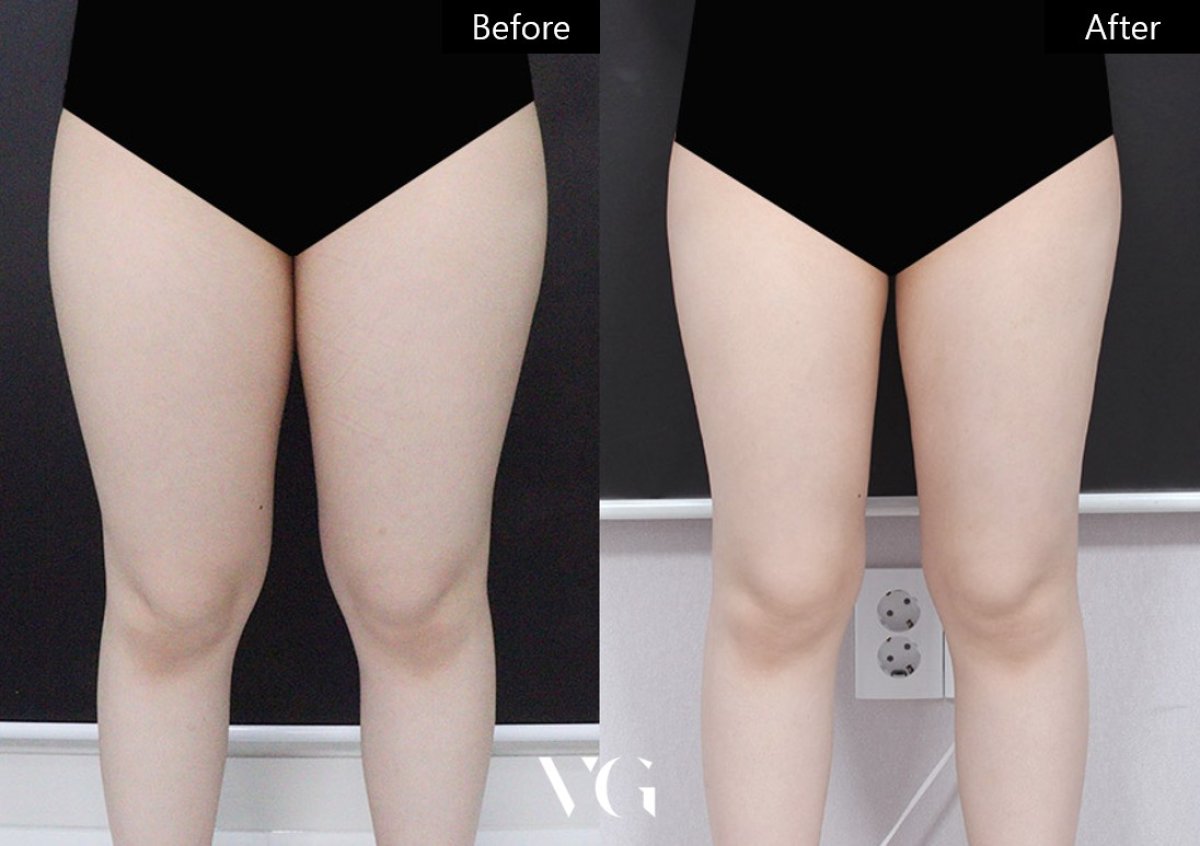 Resultados de liposucción antes y después en VG Plastic Surgery, muslos más delgados y contorno mejorado