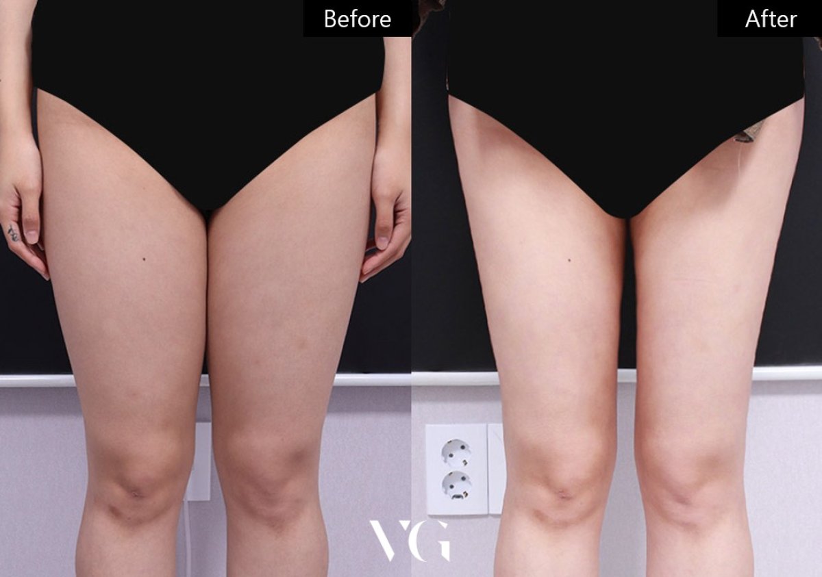 Resultados de liposucción de muslos antes y después en VG Plastic Surgery, mejora visible