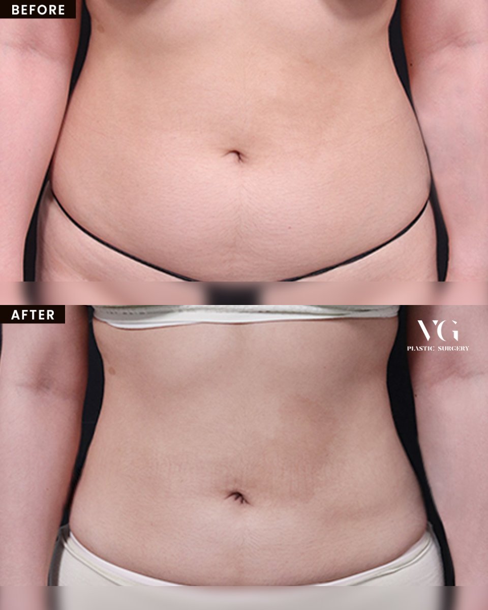 Resultados de liposucción antes y después en VG Plastic Surgery, mejora visible del abdomen