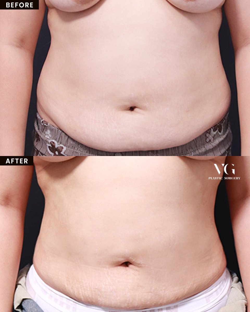 نتائج شفط الدهون قبل وبعد في VG Plastic Surgery، تحسين واضح في محيط البطن