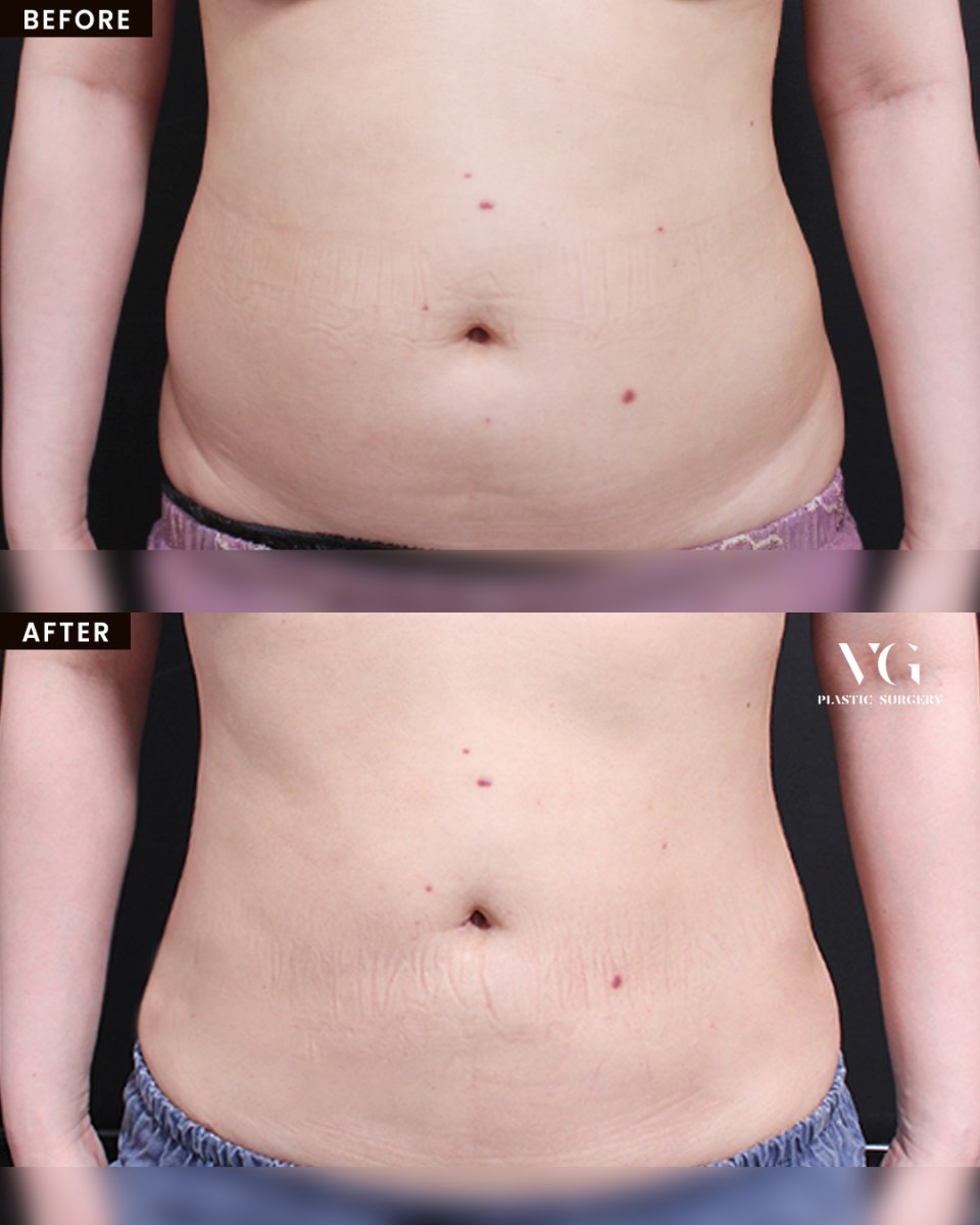 Resultados de liposucción antes y después en VG Plastic Surgery – abdomen más definido