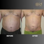 Ergebnisse der Vaser-Fettabsaugung durch Dr. Dr Phatcharasak Kraisornphongsakul Md — Vorher- und Nachher-Fotos des Patienten Fotos vor und nach Vaser-Fettabsaugung durch Dr. Dr Phatcharasak Kraisornphongsakul Md