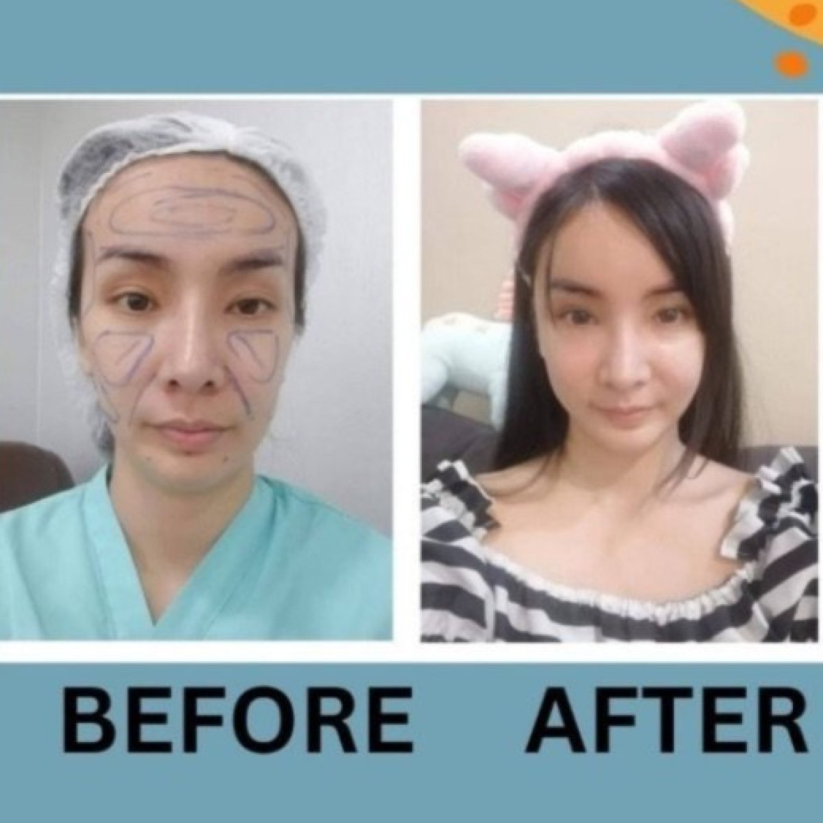 Before and after endoscopic facelift results at ID Clinic Bangkok, facial rejuvenation visible