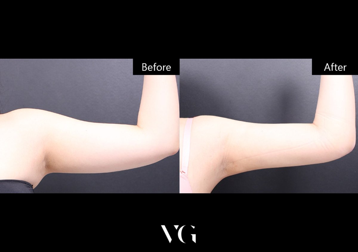Before and after arm liposuction results at VG Plastic Surgery – slimmer upper arm contour