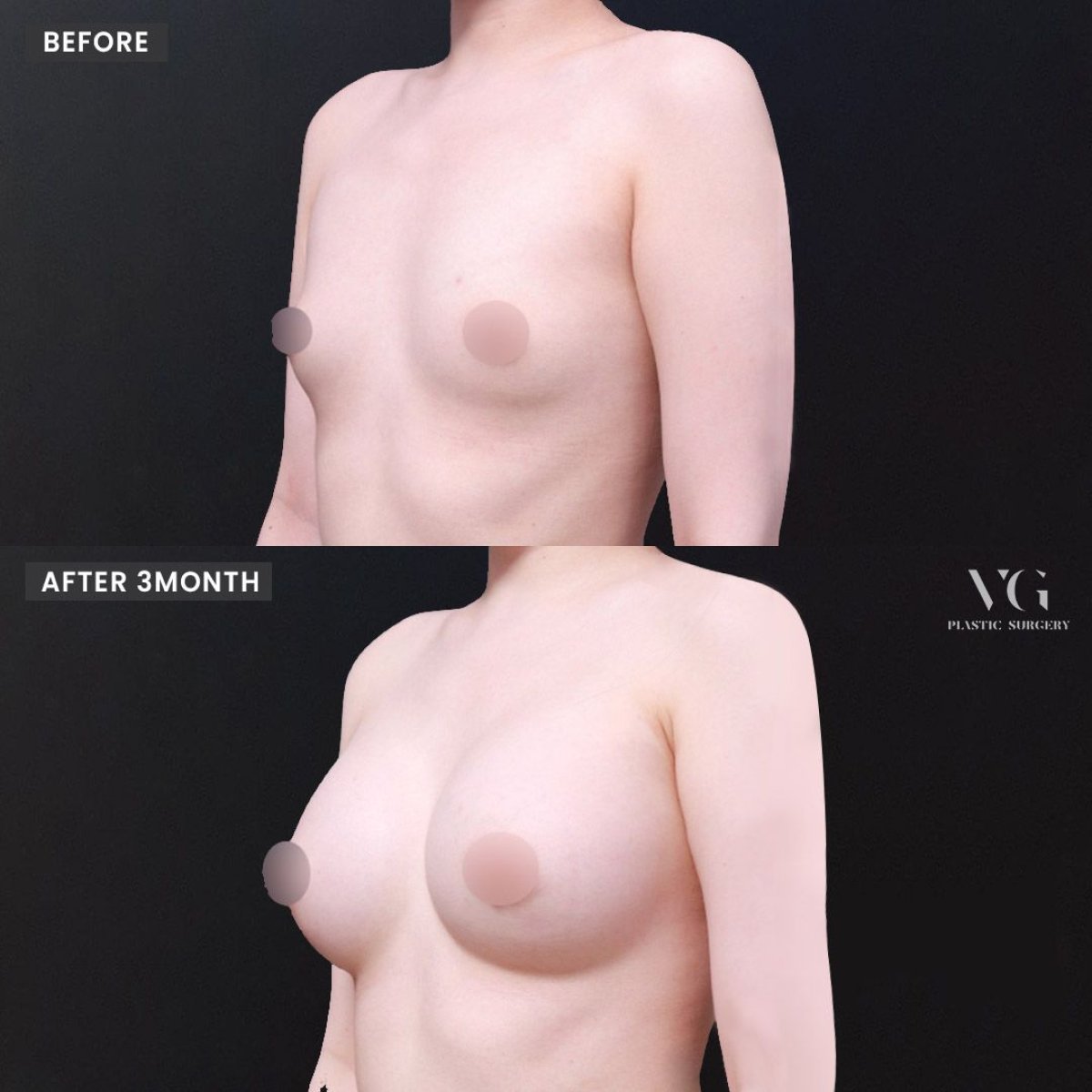 Vorher-nachher-Ergebnis der Mammoplastik bei VG Plastic Surgery – sichtbares Brustvolumen
