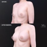 Фото до и после маммопластики, доктор Kim Jung Hue