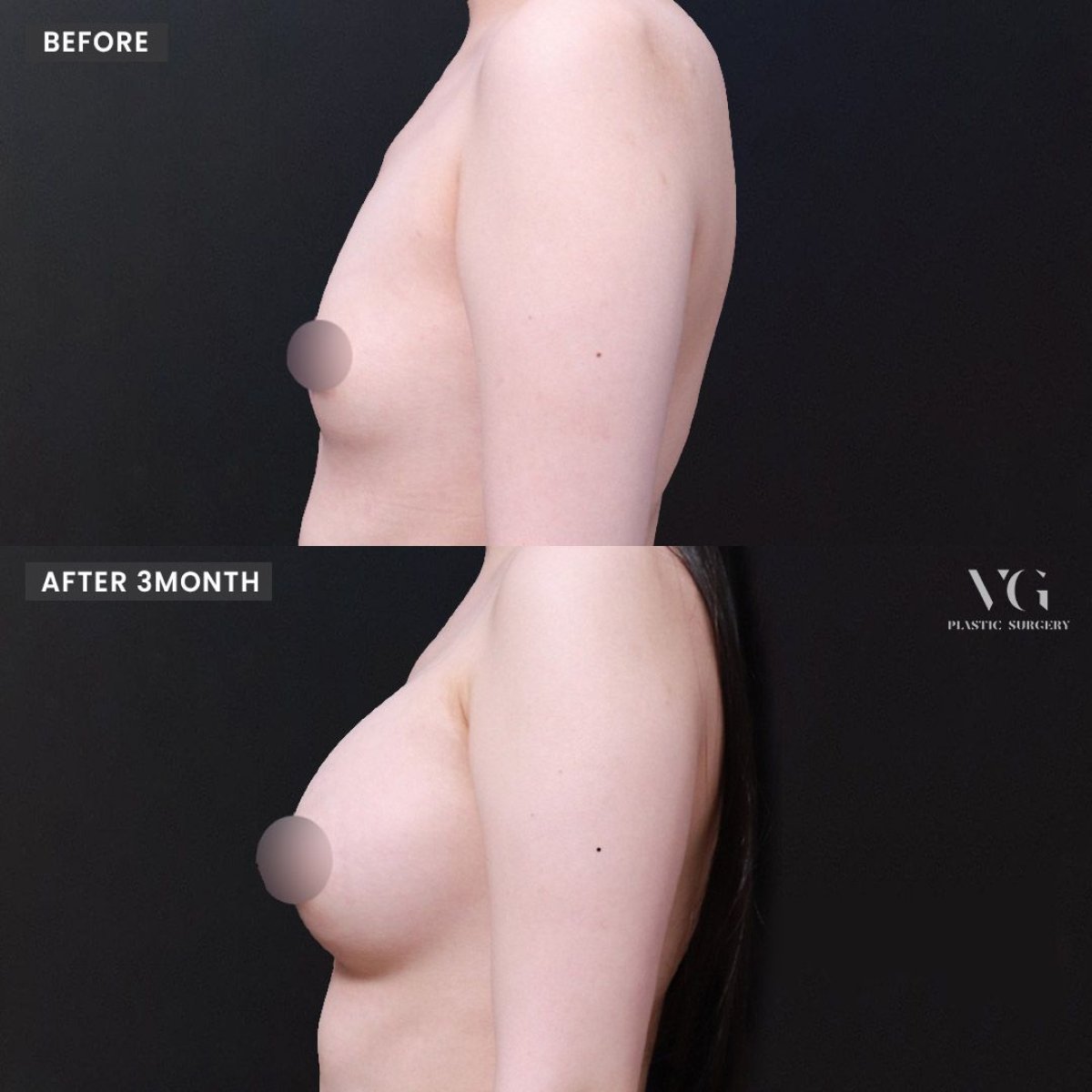 Resultados de mamoplastia antes y después en VG Plastic Surgery – mejora visible del busto
