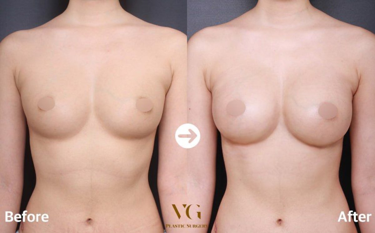 Результаты маммопластики до и после в VG Plastic Surgery, видимое увеличение груди