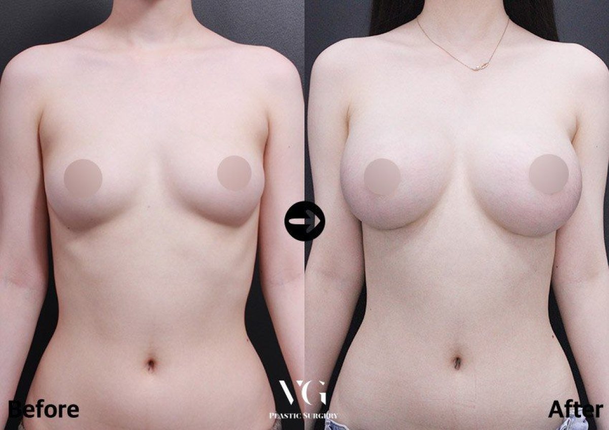 Resultados de mamoplastia antes y después en VG Plastic Surgery – aumento visible de senos