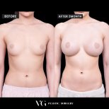 Before and after Mammoplasty photos by Dr. 