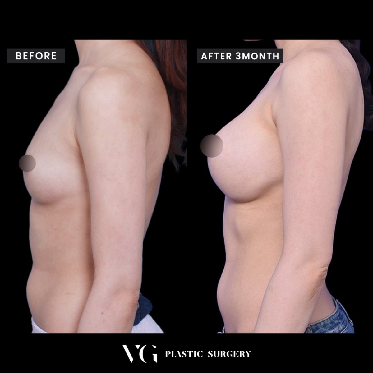 Resultados de mamoplastia antes y después en VG Plastic Surgery, aumento de pecho tras 3 meses