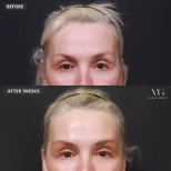 Fotos vor und nach Blepharoplastik (Augenlidkorrektur) durch Dr. 