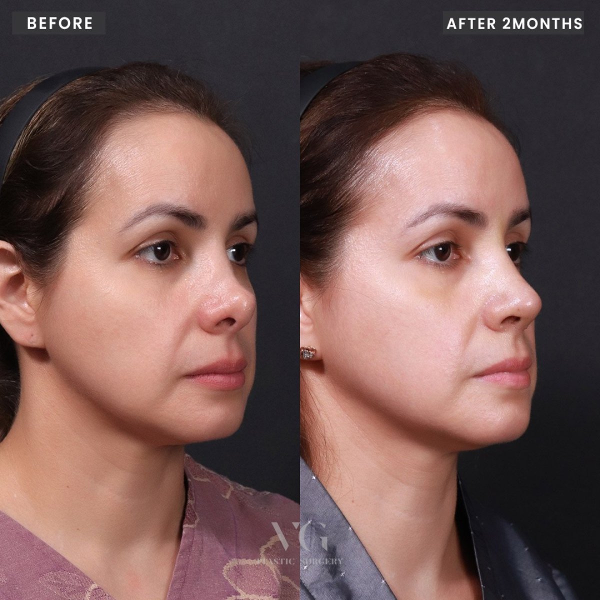 Efekty przed i po rhinoplastyce w VG Plastic Surgery, poprawiony kształt nosa po 2 miesiącach