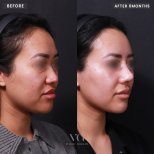 Ergebnisse der Rhinoplastik (Nasenkorrektur) durch Dr. Im Young Min — Vorher- und Nachher-Fotos des Patienten Fotos vor und nach Rhinoplastik (Nasenkorrektur) durch Dr. Im Young Min