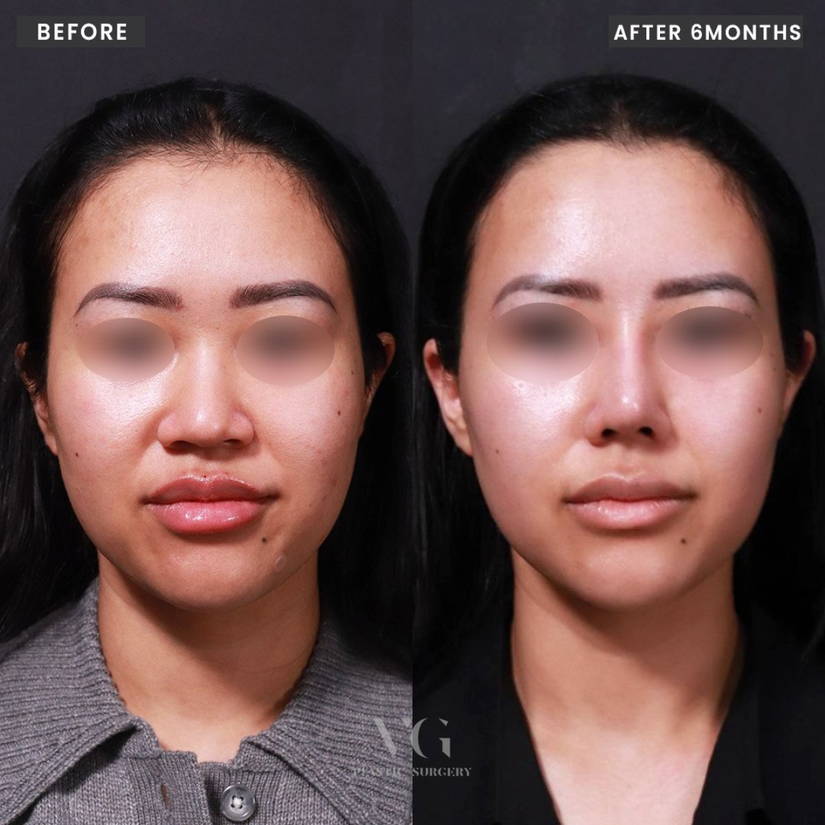 Resultados de rinoplastia antes y después en VG Plastic Surgery, remodelación nasal tras 6 meses