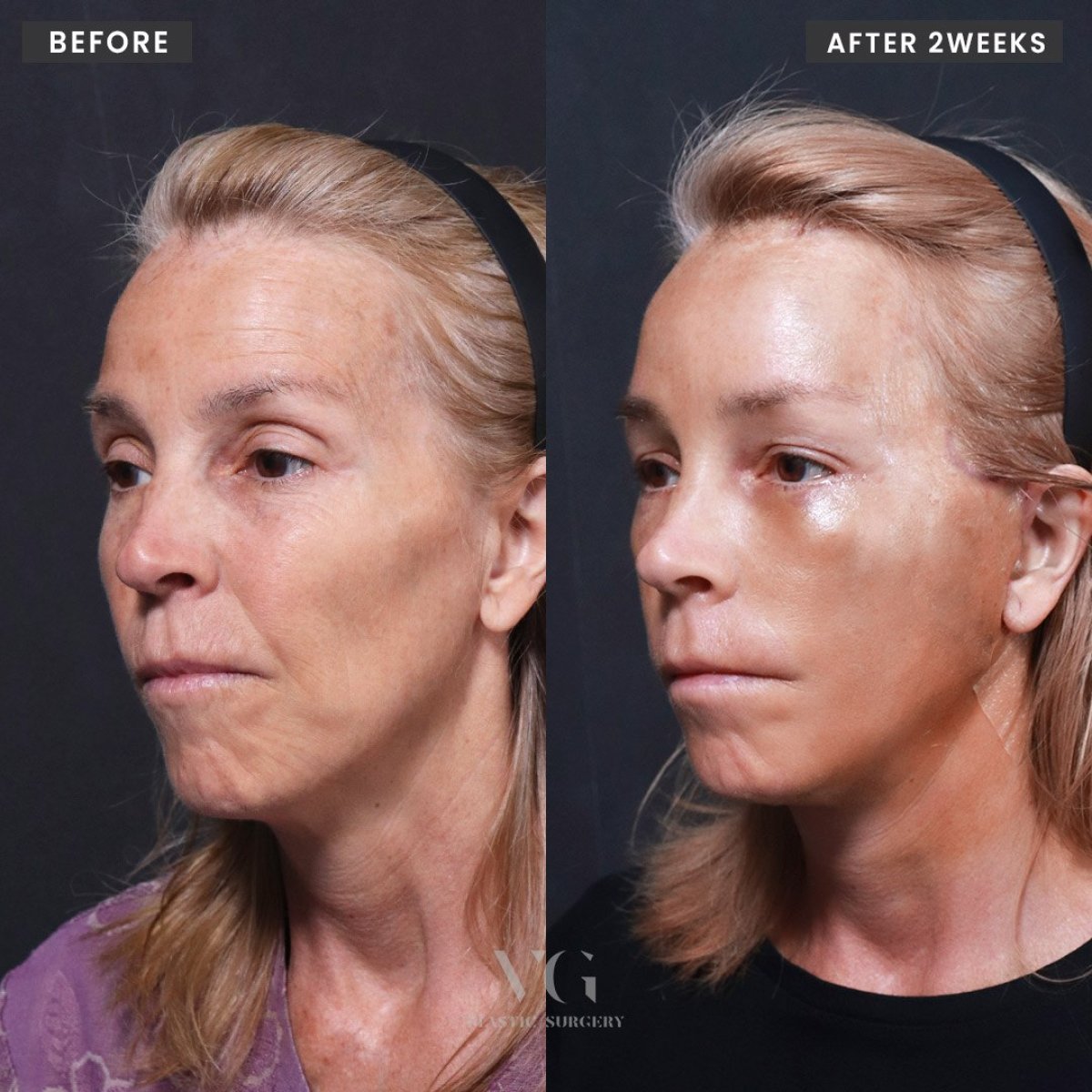 Resultados de lifting facial antes y después en VG Plastic Surgery, rejuvenecimiento a 2 semanas