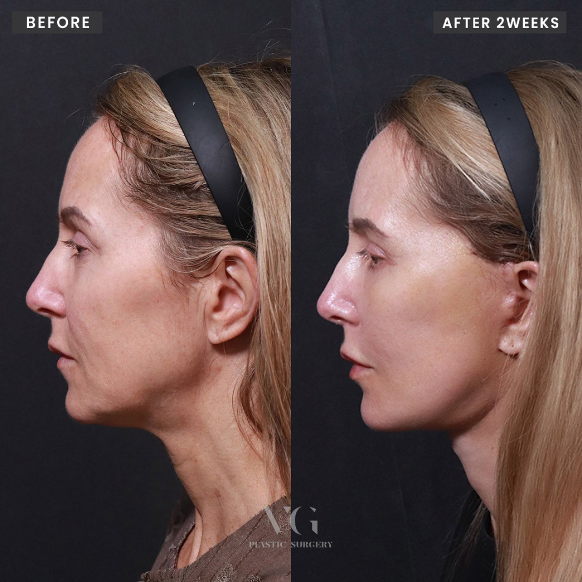 Résultats lifting visage avant/après chez VG Plastic Surgery – rajeunissement visible après 2 semaines