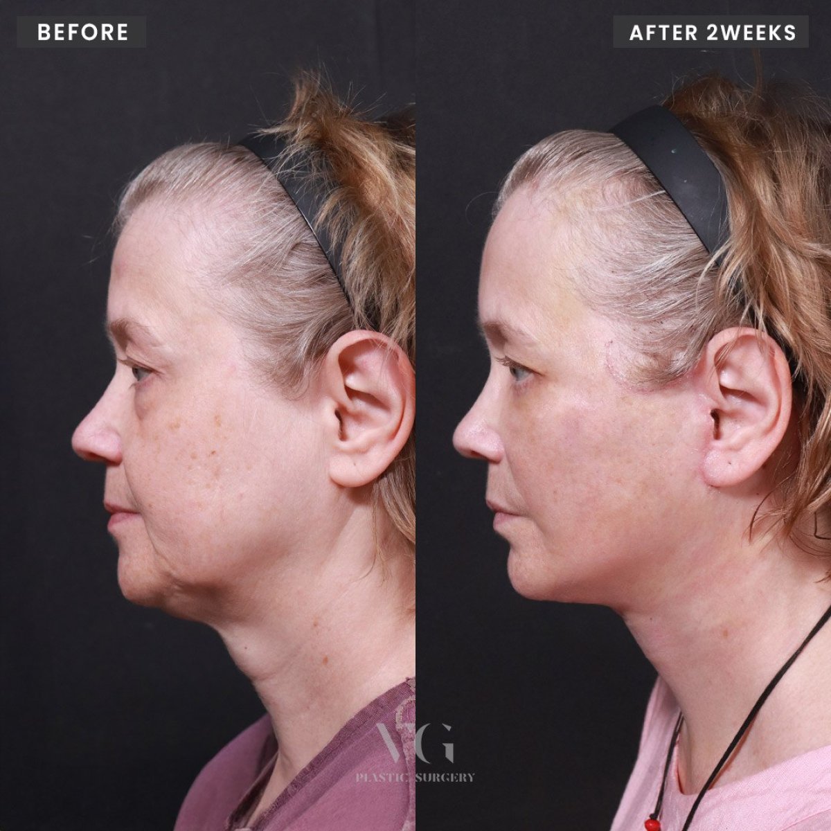 نتائج شد الوجه قبل وبعد في VG Plastic Surgery – تحسين واضح للفك والرقبة