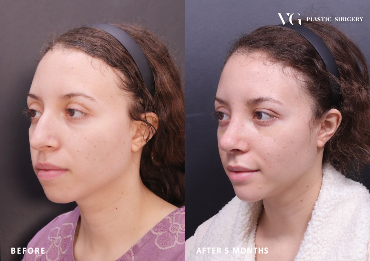Результат ринопластики до и после в VG Plastic Surgery, коррекция носа через 5 месяцев