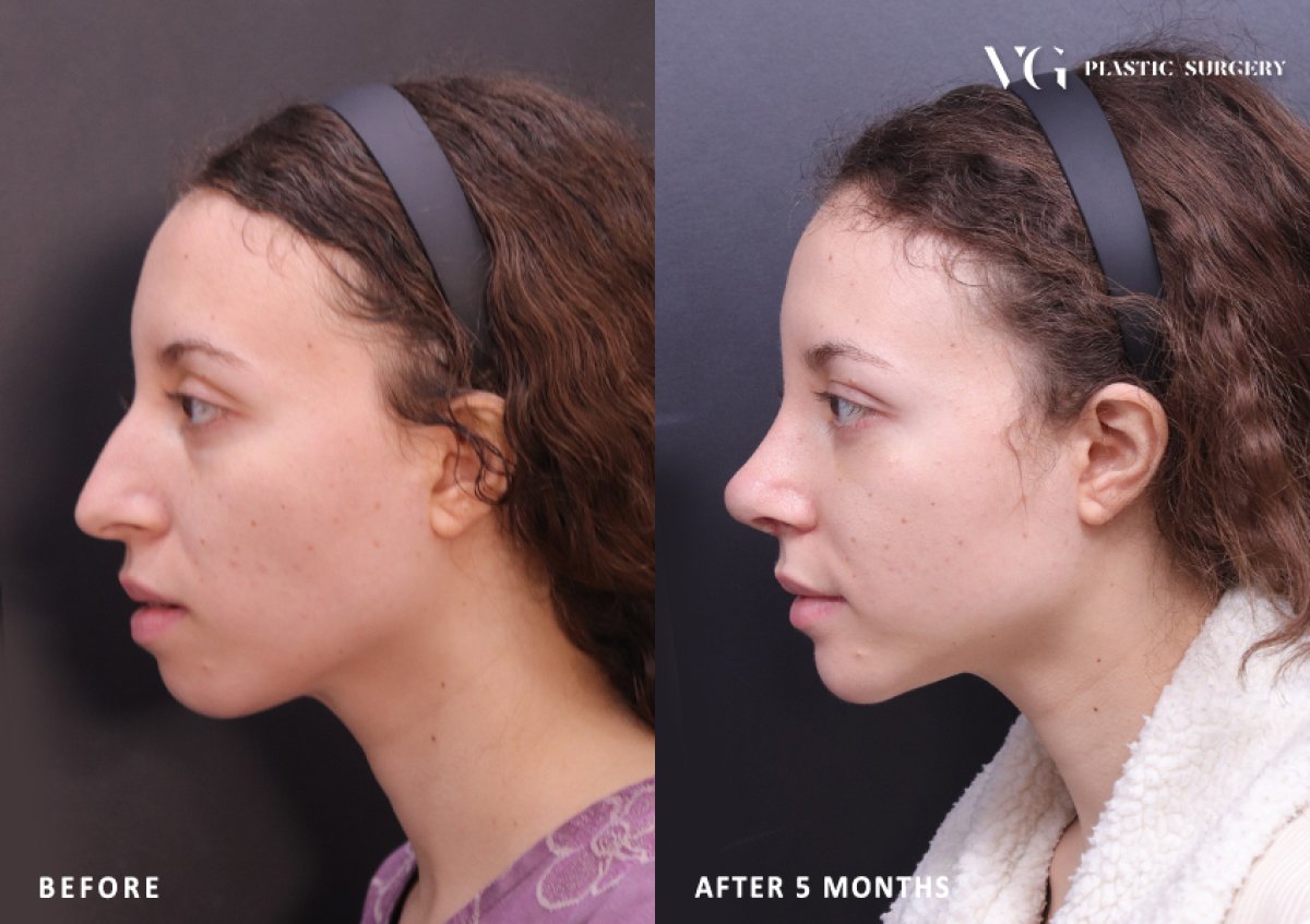 Resultados de rinoplastia antes y después en VG Plastic Surgery, remodelación nasal tras 5 meses