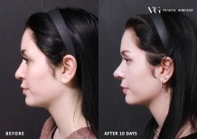 Rhinoplasty (nose job) results by Dr. Kim Jung Hue - Patient’s before and after images Before and after Rhinoplasty (nose job) photos by Dr. Kim Jung Hue