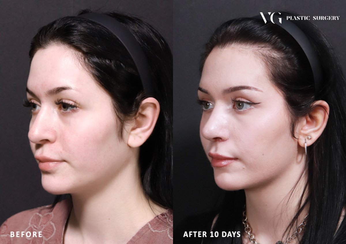 Résultats avant et après rhinoplastie chez VG Plastic Surgery, nez amélioré après 10 jours