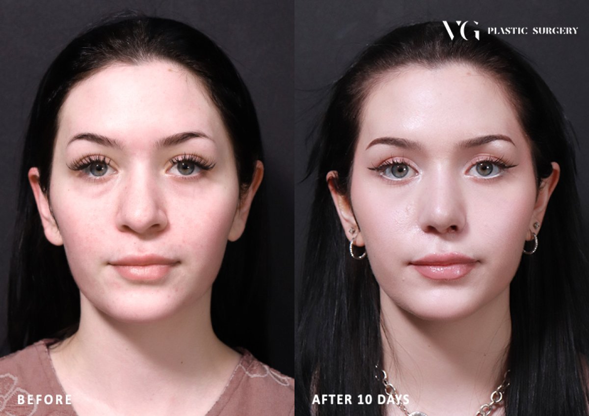 Resultados de rinoplastia antes y después en VG Plastic Surgery, cambio de nariz tras 10 días