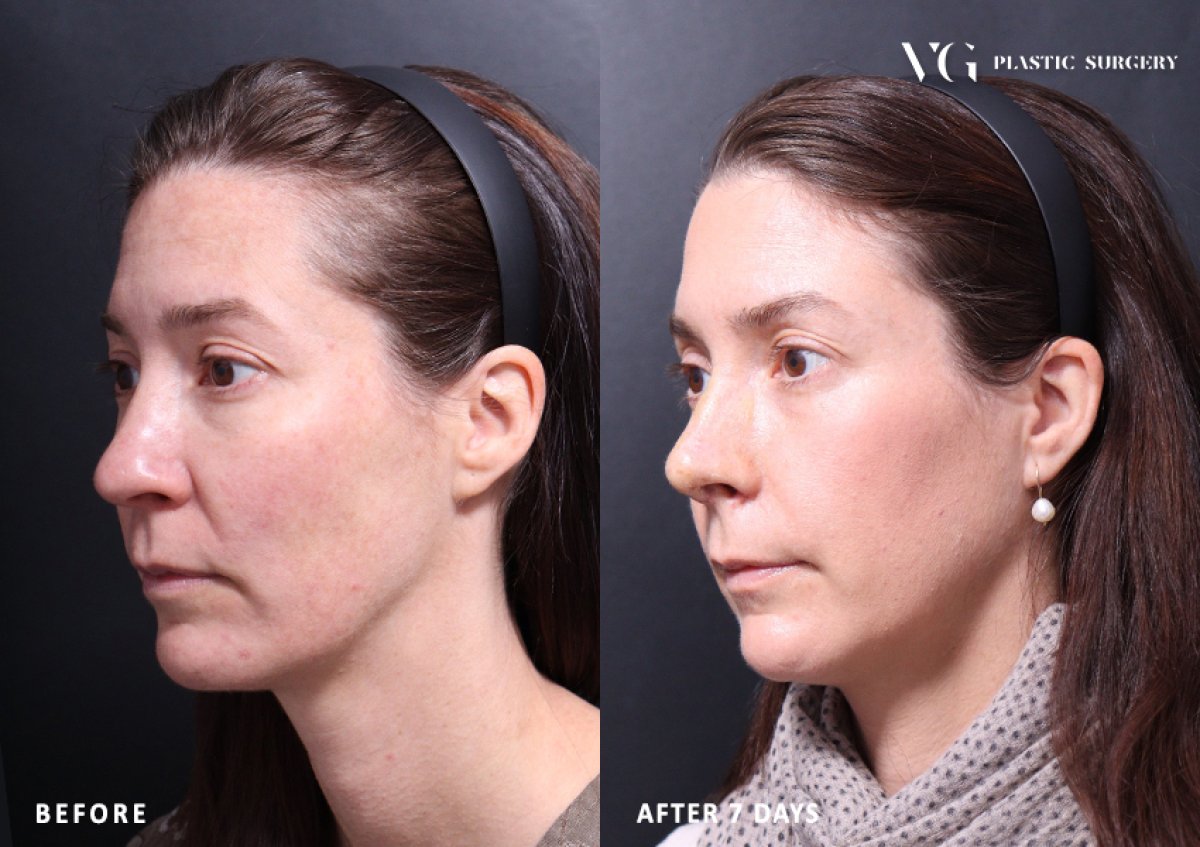 Resultados de rinoplastia antes y después en VG Plastic Surgery, remodelación nasal tras 7 días
