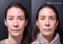 Ergebnisse der Rhinoplastik (Nasenkorrektur) durch Dr. — Vorher- und Nachher-Fotos des Patienten Fotos vor und nach Rhinoplastik (Nasenkorrektur) durch Dr.