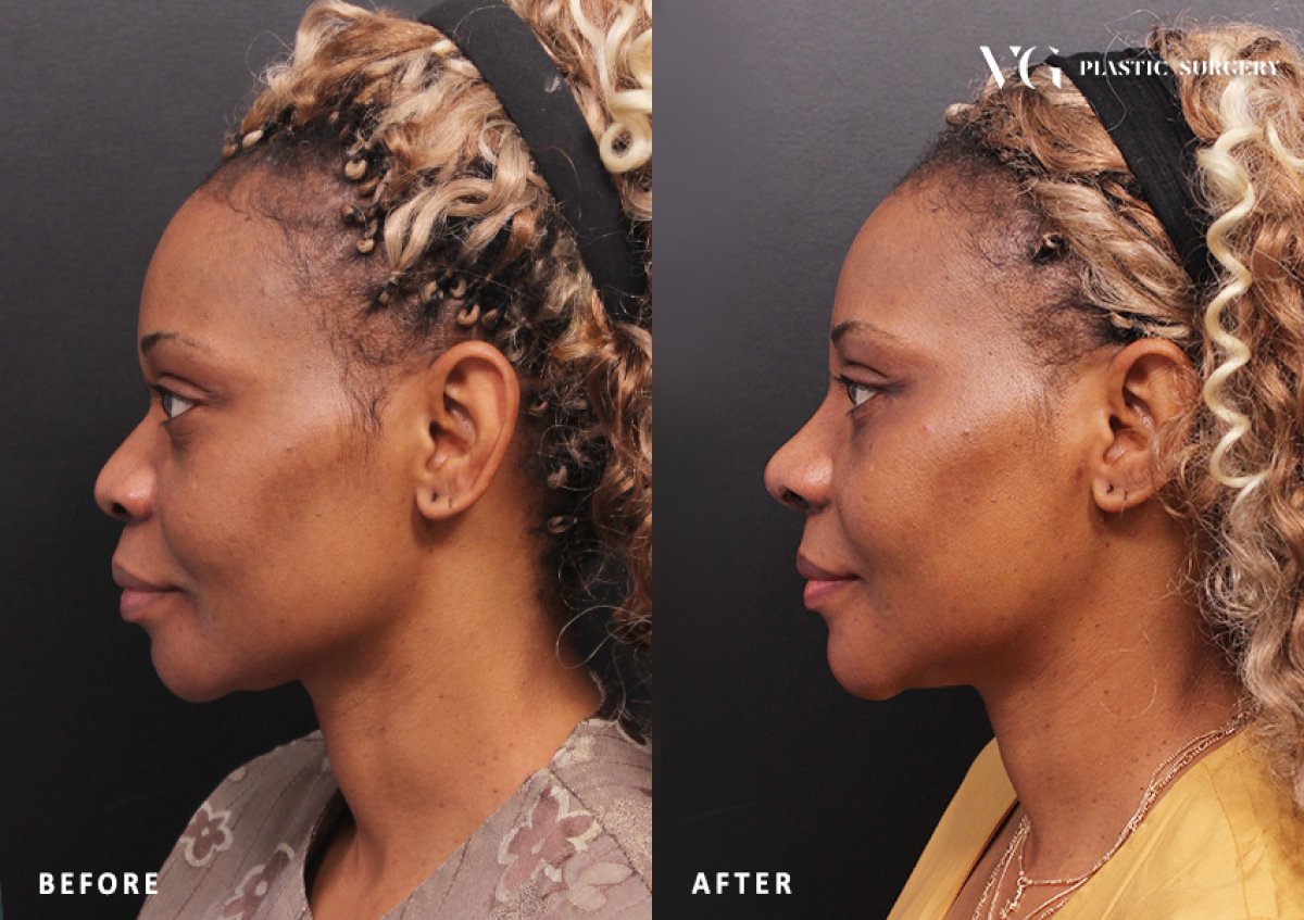 نتائج تجميل الأنف قبل وبعد في VG Plastic Surgery، تحسين شكل الأنف والملامح