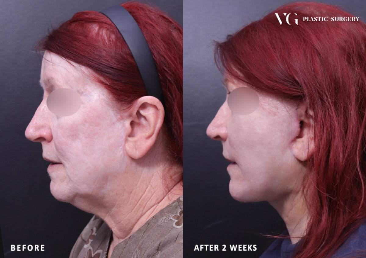 Resultados de lifting facial antes y después en VG Plastic Surgery, rejuvenecimiento en 2 semanas