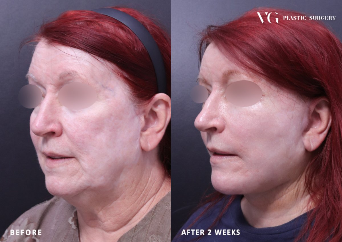 Résultats lifting visage avant/après chez VG Plastic Surgery – rajeunissement après 2 semaines