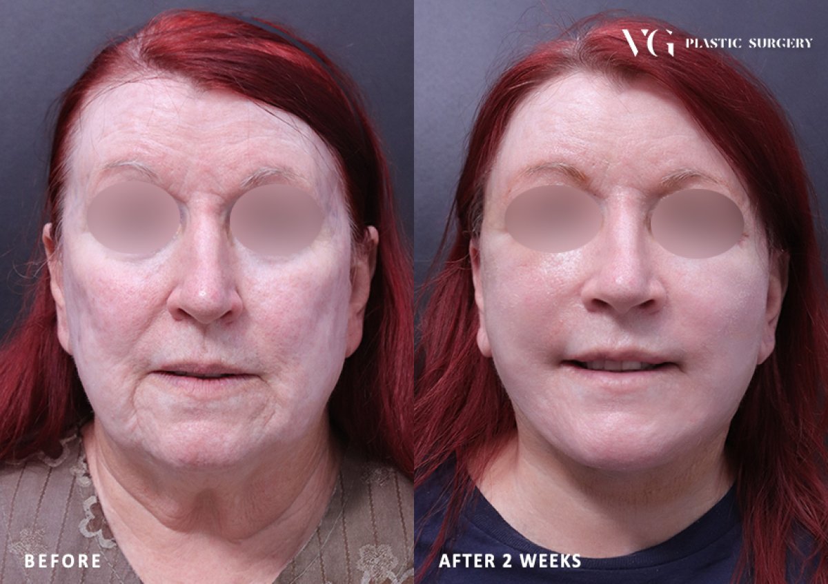 Resultados de lifting facial antes y después en VG Plastic Surgery, rejuvenecimiento facial a 2 semanas
