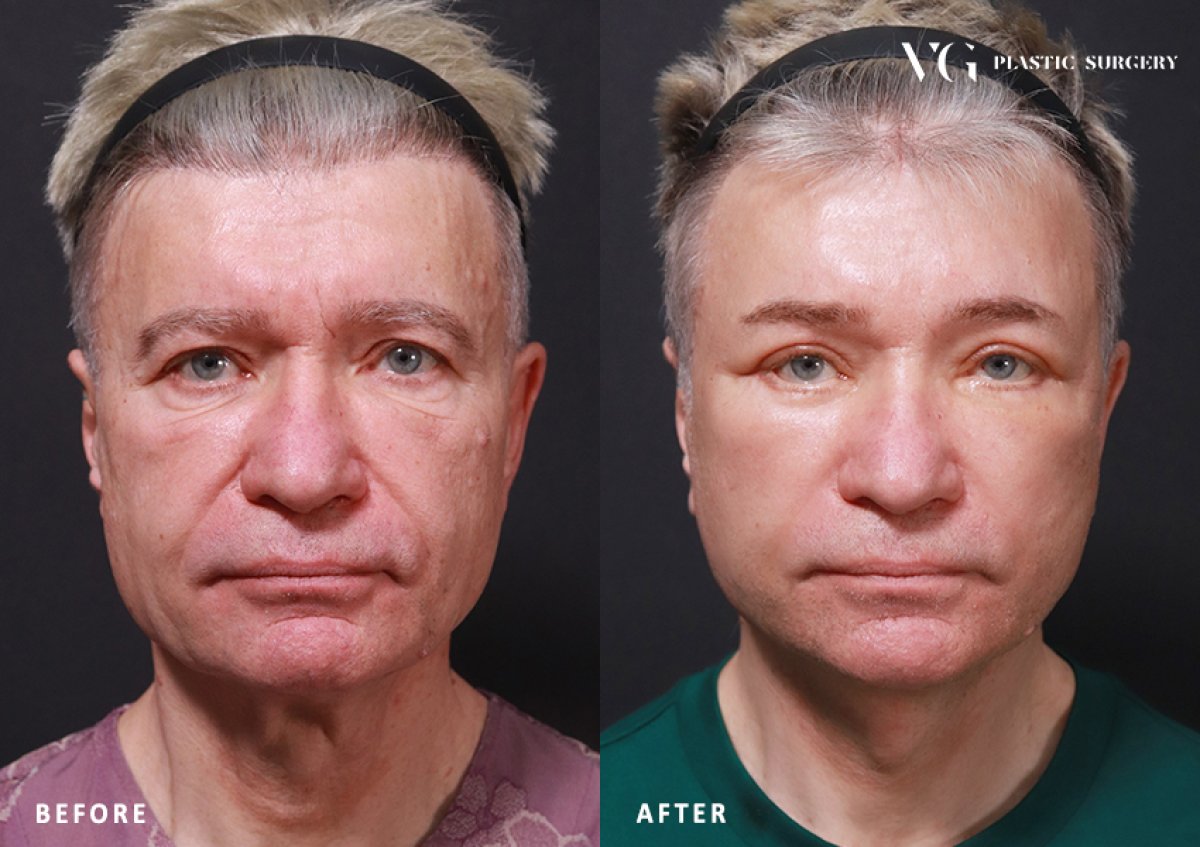 نتائج رأب الجفن قبل وبعد في VG Plastic Surgery، تصحيح الجفون للرجال