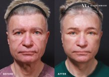 Dr.  тарапынан Блефаропластика (қабақ қалыпқа келтіру) бұрын және кейін фотосуреттері