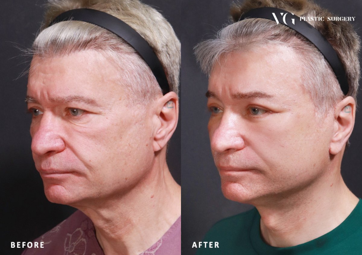 Resultados de blefaroplastia antes y después en VG Plastic Surgery, corrección de párpados masculina