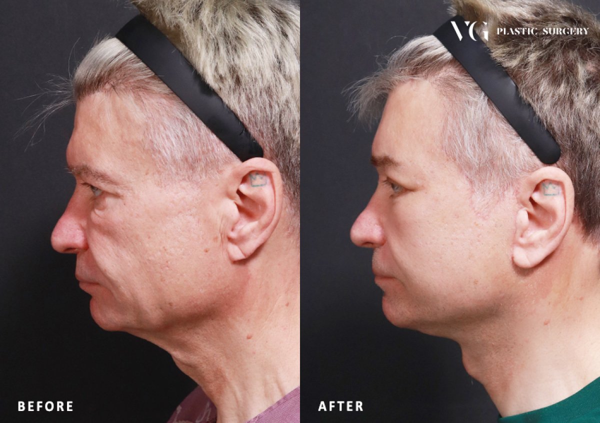 Resultados de lifting facial antes y después en VG Plastic Surgery, rejuvenecimiento facial masculino