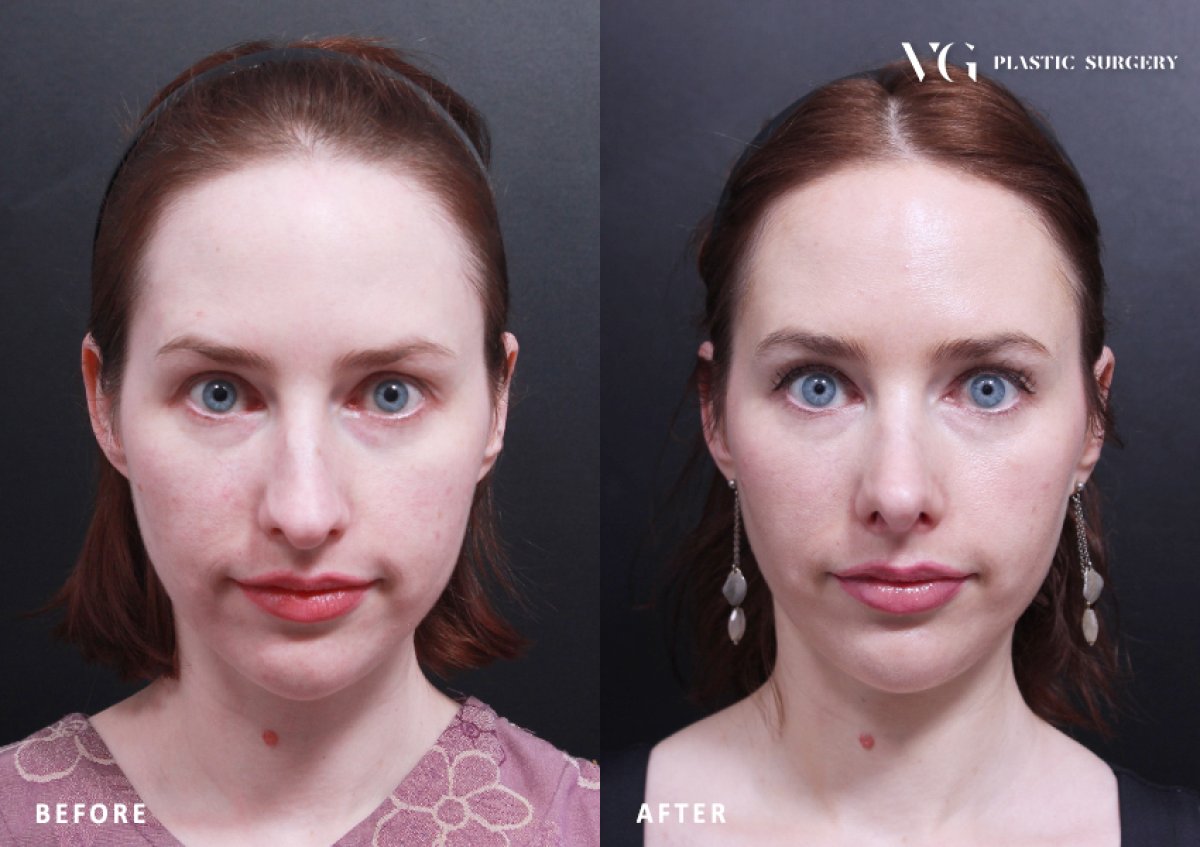 نتائج عملية تجميل الأنف قبل وبعد في VG Plastic Surgery، إعادة تشكيل الأنف بمظهر طبيعي