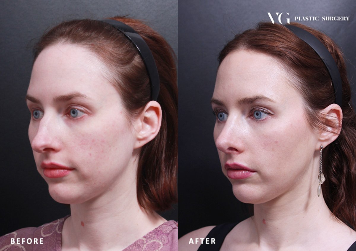 Before and after rhinoplasty results at VG Plastic Surgery, nose reshaping with natural look