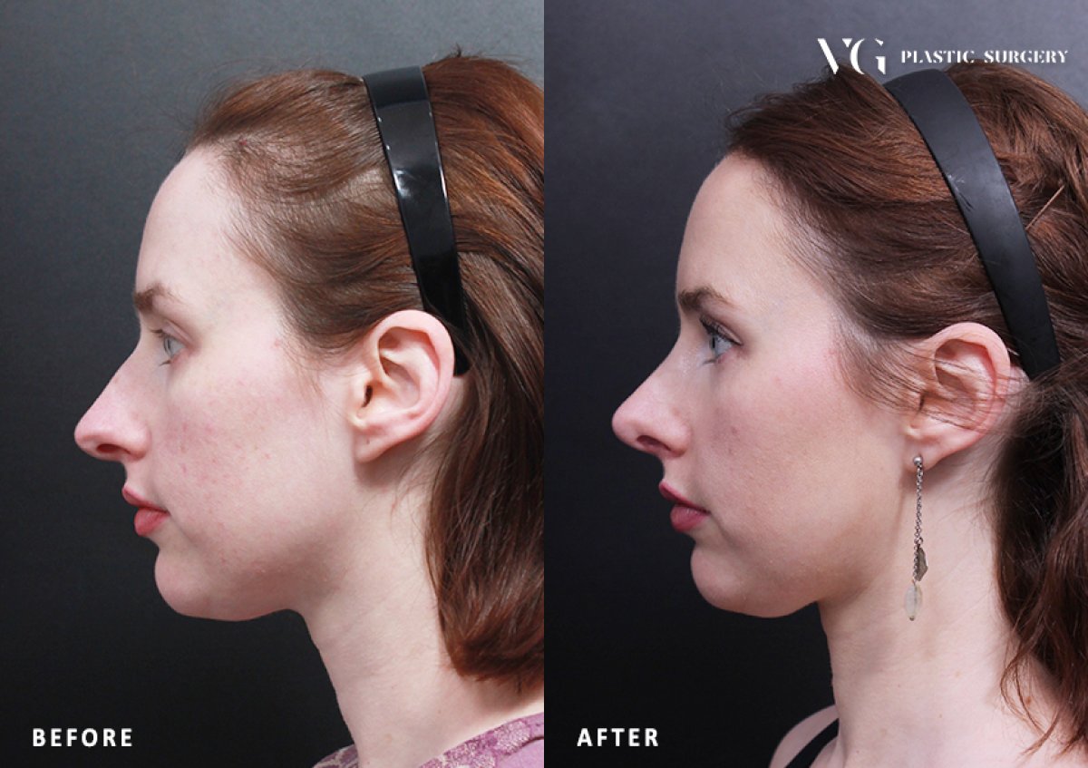 Résultats avant et après rhinoplastie chez VG Plastic Surgery, profil du nez amélioré
