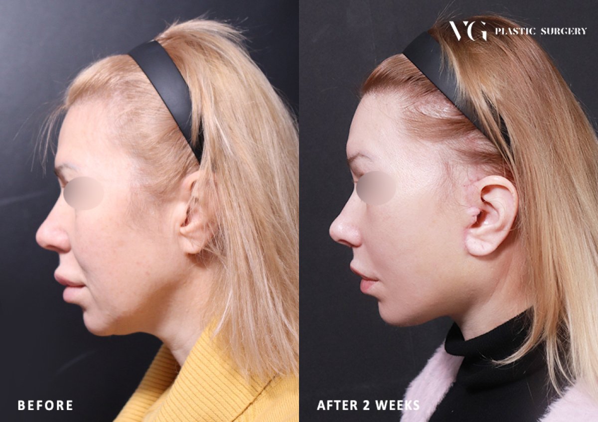 Resultados de lifting facial antes y después en VG Plastic Surgery – mejora del contorno facial