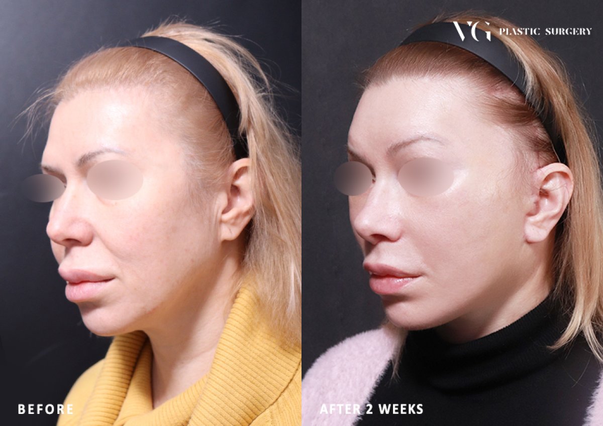Facelift before and after results at VG Plastic Surgery, visible facial rejuvenation after 2 weeks