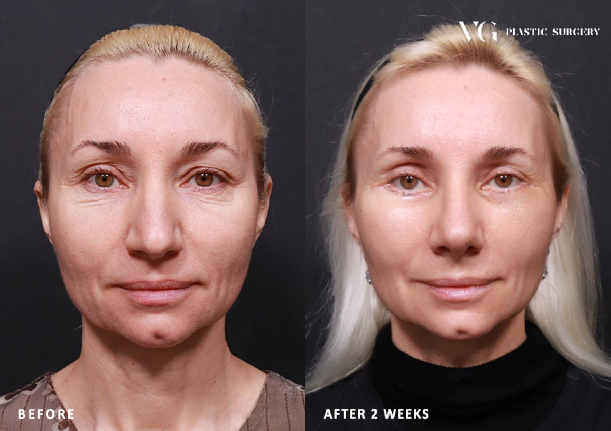 Résultats de blépharoplastie avant/après chez VG Plastic Surgery – correction des paupières