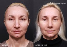 Fotos vor und nach Blepharoplastik (Augenlidkorrektur) durch Dr. 