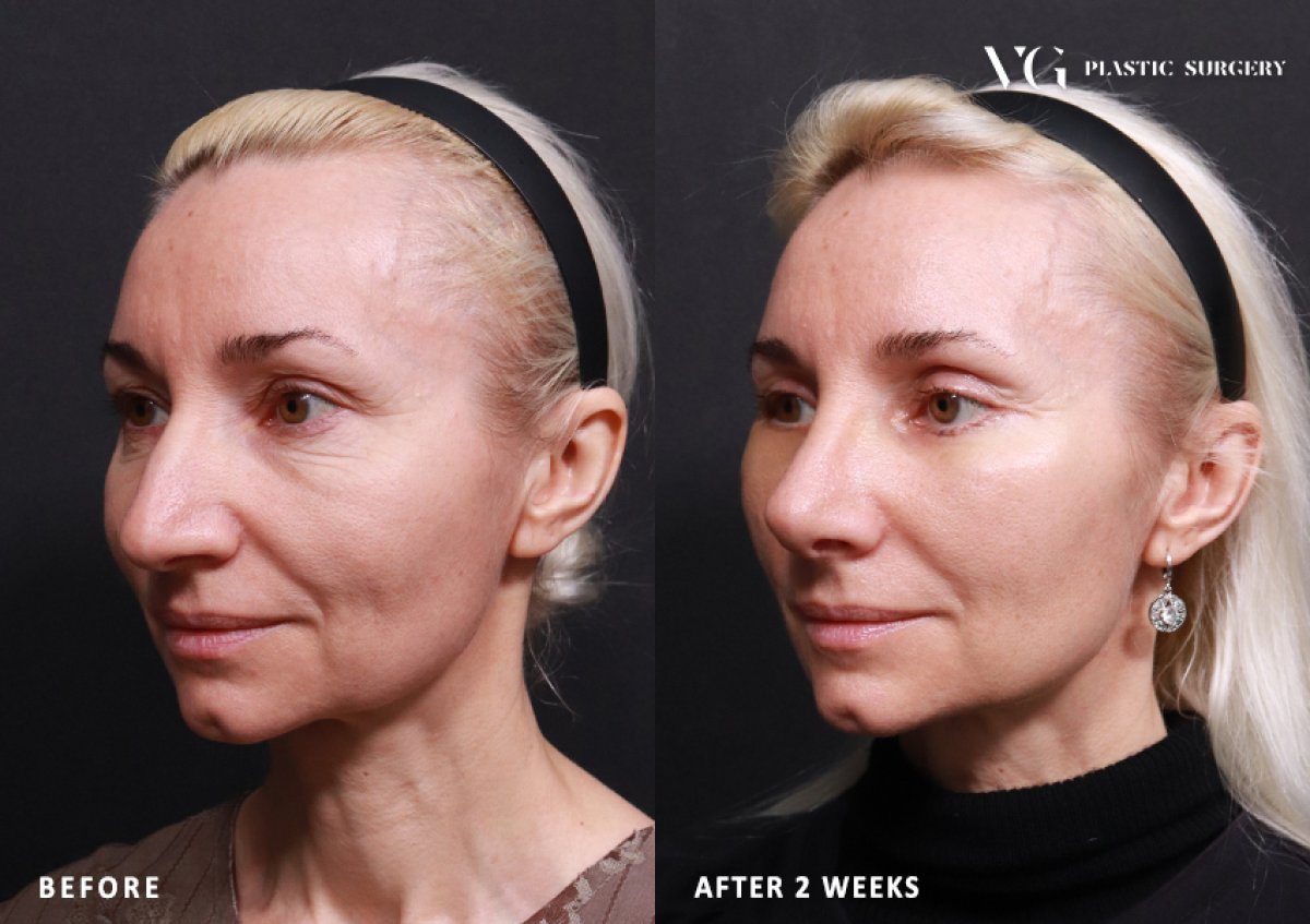 Resultados de blefaroplastia antes y después en VG Plastic Surgery, corrección de párpados a 2 semanas