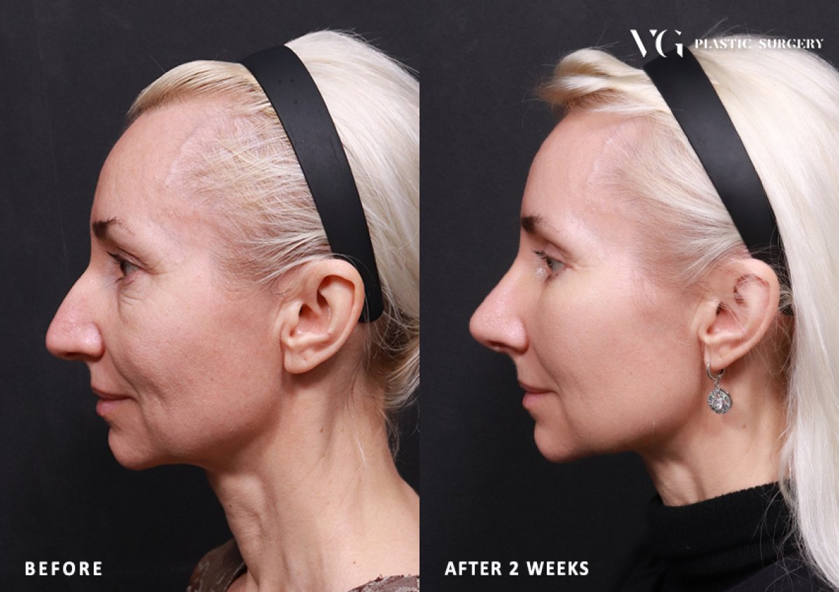 Результати підтяжки обличчя до і після у VG Plastic Surgery – омолодження за 2 тижні