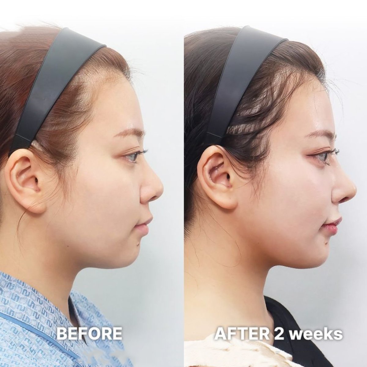Résultats avant/après rhinoplastie de la pointe chez Returning Plastic Surgery, nez remodelé